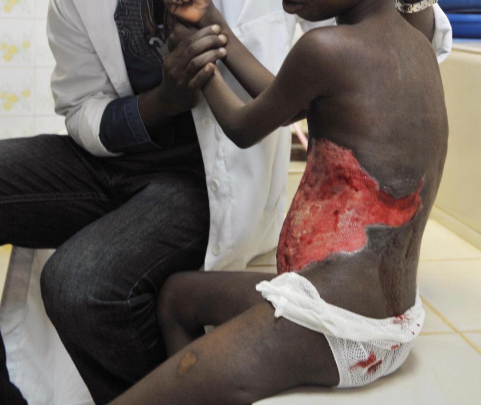 A doctor gives comfort to a child suffering from Buruli ulcer at a clinic in Ivory Coast, on Sept. 12, 2009. (Photo: ISSOUF SANOGO/AFP/Getty Images)