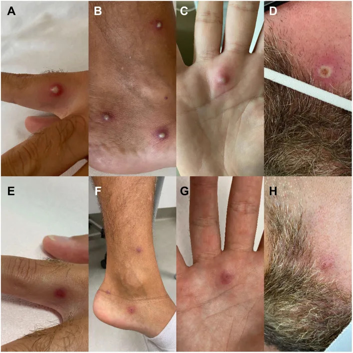 monkeypox lesions in a coinfected patient