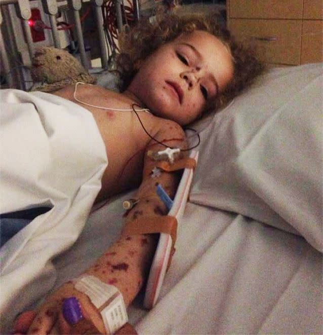 Little Jazmyn suffered a fever and had a small bruise on her chest just hours before the condition took hold of her body. Photo: Facebook/Jazmyn's meningococcal B journey