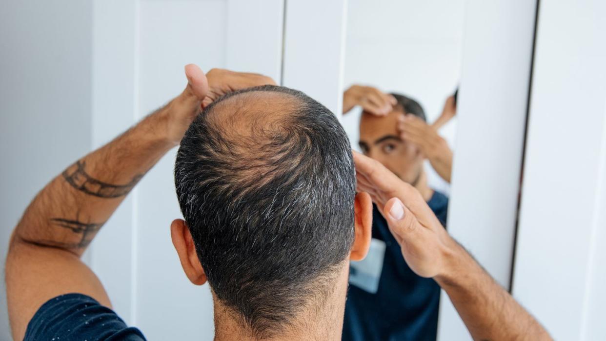 bald man looking mirror at head baldness and hair loss