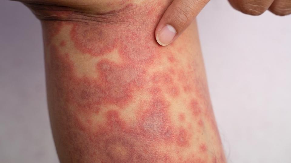 A woman with eczema