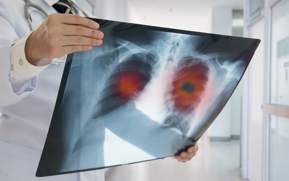 A doctor inspecting an x-ray of a patient with lung cancer.