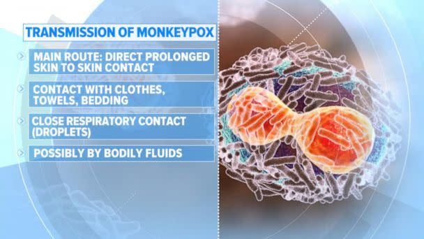 PHOTO: What to know about monkeypox as the virus continues to spread in the United States. (ABC News)