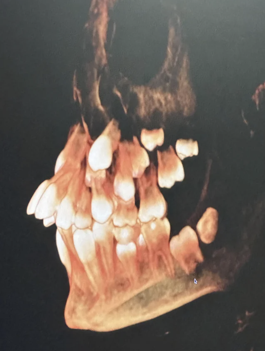 X-ray image of a human skull showing detailed teeth structure