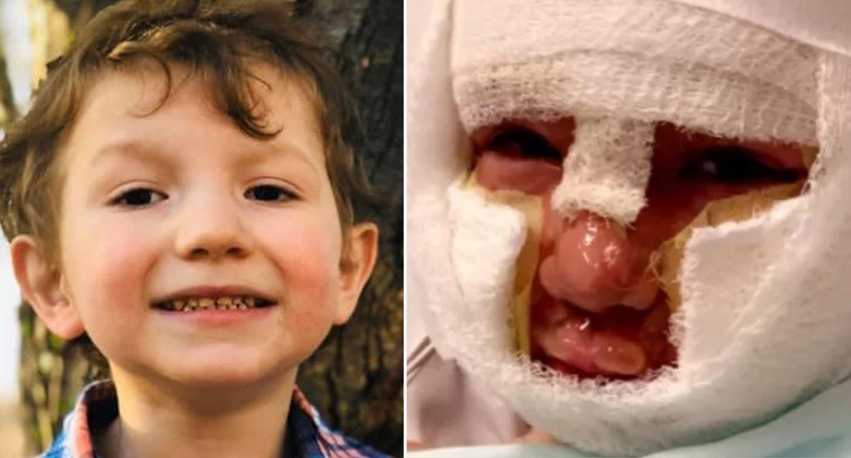 Dominick Krankall smiling before accident (left) Dominick Krankall with burns and blisters on his face covered in bandages (right)
