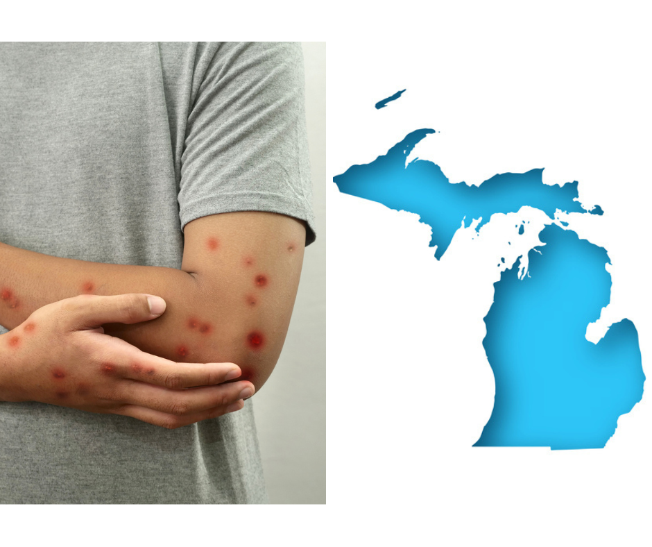Michigan has reported three cases of measles in recent weeks.
