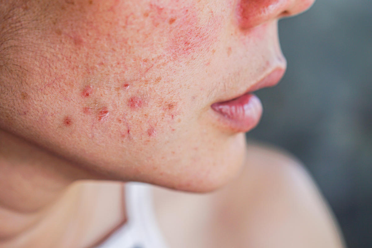 Roaccutane : nouvel avertissement contre le médicament anti-acné