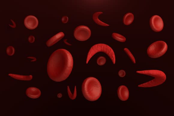 Normal and sickled red blood cells