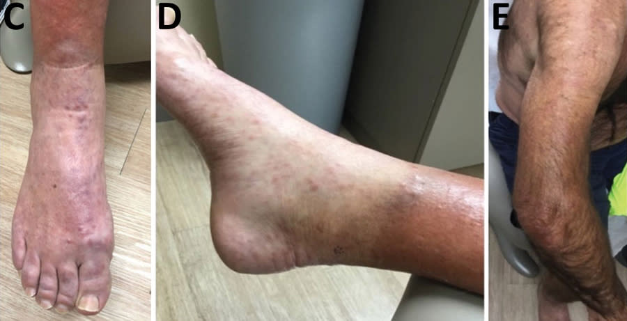 Lepromatous leprosy in a 54-year-old man in central Florida in 2022. (CDC)