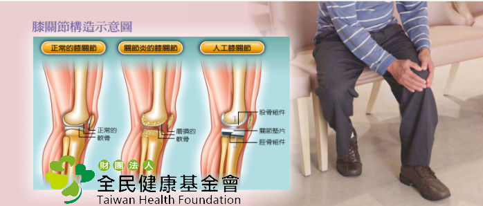 台灣每年進行約3萬例膝關節置換術，需要換關節通常是因為肥胖、肌肉無力、曾經受傷和關節變形，使關節加速磨損。