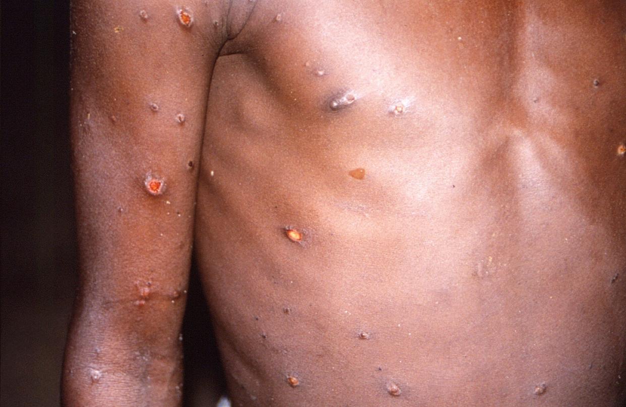 Skin lesions on the arms and torso of a person infected with mpox