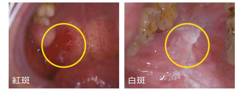 口腔癌前病變：白斑及紅斑都有可能是癌前病變狀態，日後有機率會轉成口腔癌。（圖／李正喆醫師提供）