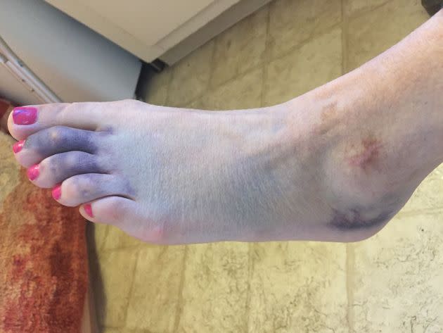 The second ankle shatter that led to the diagnosis in 2018