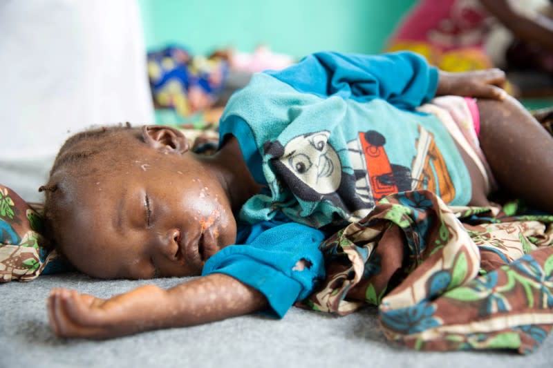 Dobo Mbanza, who developed complications that may leave her blind after contracting measles, lies on a bed in the measles isolation ward in Boso-Manzi hospital in Mongala province