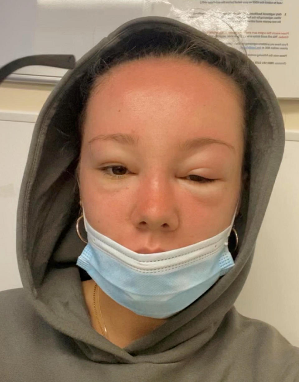 McGlynn's severe sunburn left her with a swollen face. (Orla McGlynn/SWNS)