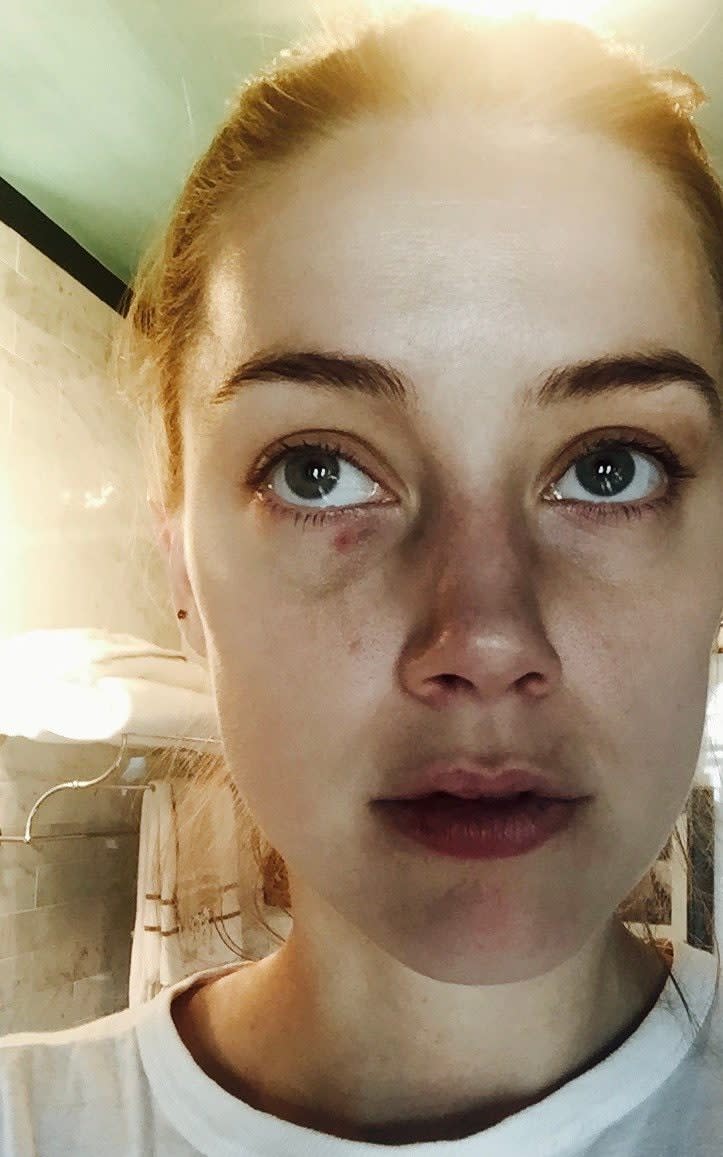 injuries said to have been sustained by Amber Heard during an incident in which Johnny Depp has admitted to "accidentally" headbutting her - PA