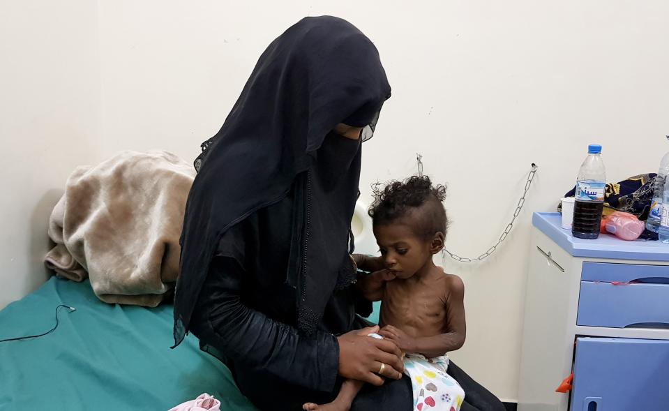 MARIB, YEMEN – DECEMBER 13 : A woman holds her baby, who is suffering from severe malnutrition, in Marib, Yemen on December 13, 2018. Many children are affected by the famine as a consequence of ongoing war and conflicts in Yemen. Refugees try to make their way to a hospital in Marib in the central Yemen for their children to receive treatment. (Photo by Said Ibicioglu/Anadolu Agency/Getty Images)