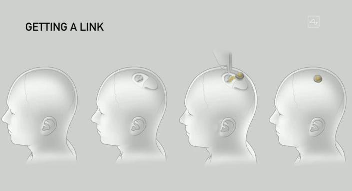 Elon Musk said the Neuralink device would replace a piece of skull without causing any lasting damage to the brain (Neuralink)