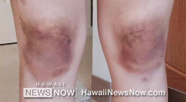 Linnie Ikeda, 24, was diagnosed with Gardner-Diamond syndrome which causes random bruising and is associated with stress and anxiety. Photo: Hawaii Now