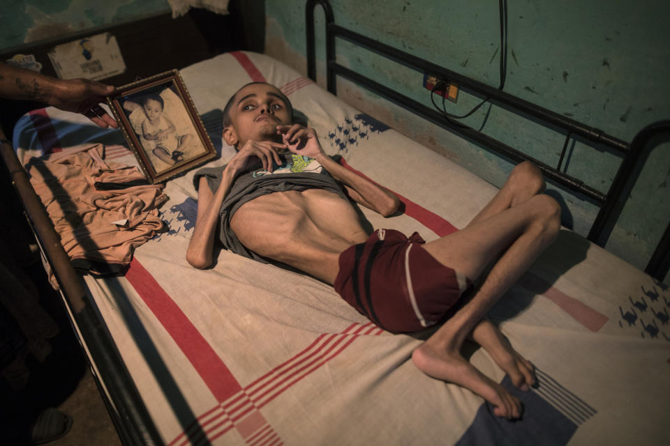 Miguel Blanco, who was born with Hydrocephalus, lays in a bed where his brother places a photograph of him when he was a toddler in Maracaibo, Venezuela, Nov. 27, 2019. Blanco, 28, lives with his unemployed mother who can only afford to feed him once a day. (AP Photo/Rodrigo Abd)