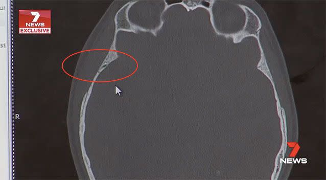 A tiny fracture from the fall caused Sam's brain to hemorrhage, pushing his brain 1.5cm. Source: 7 News