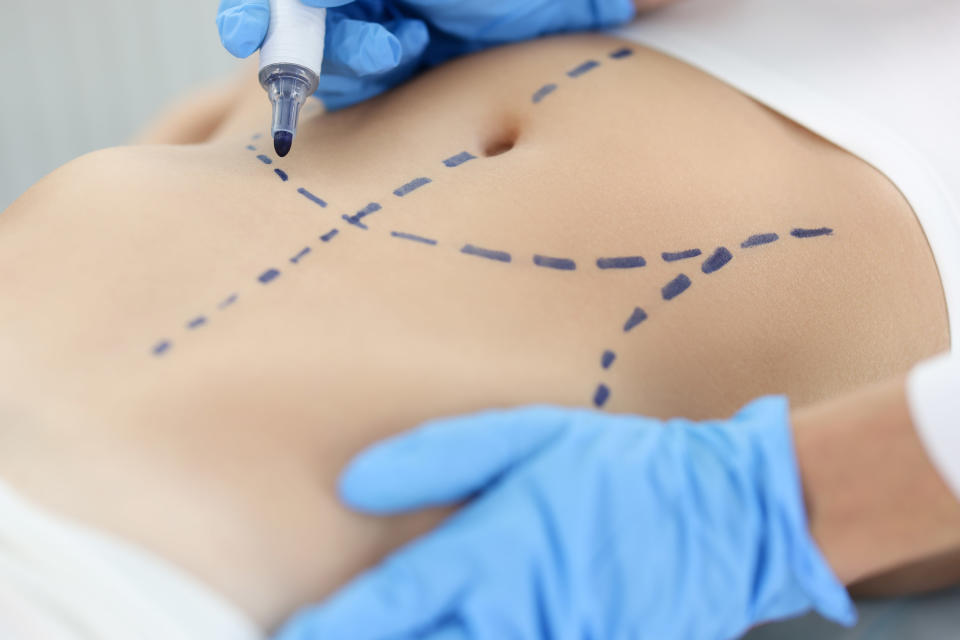 A doctor draws lines on a patient's stomach in preparation for a tummy tuck procedure