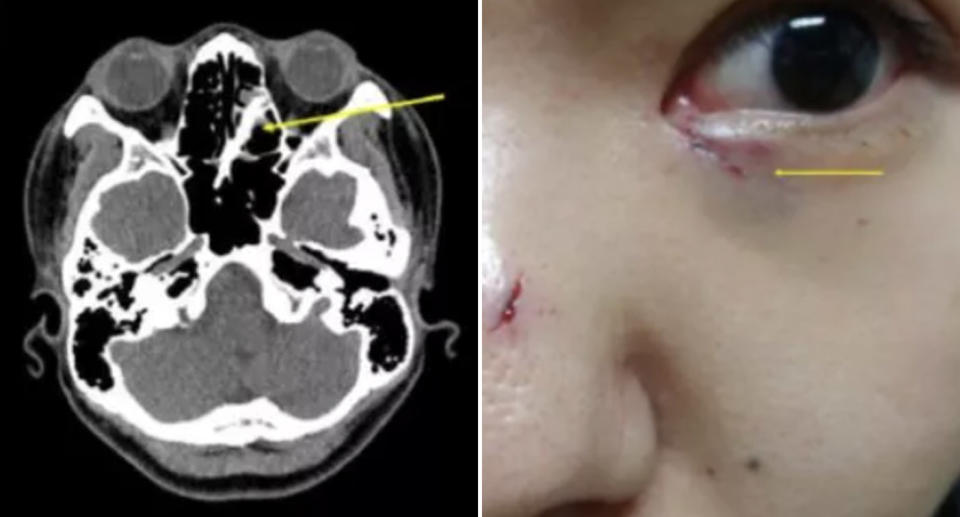 A CT scan shows chopsticks lodged in a woman's nose. Her face is also pictured with cuts.