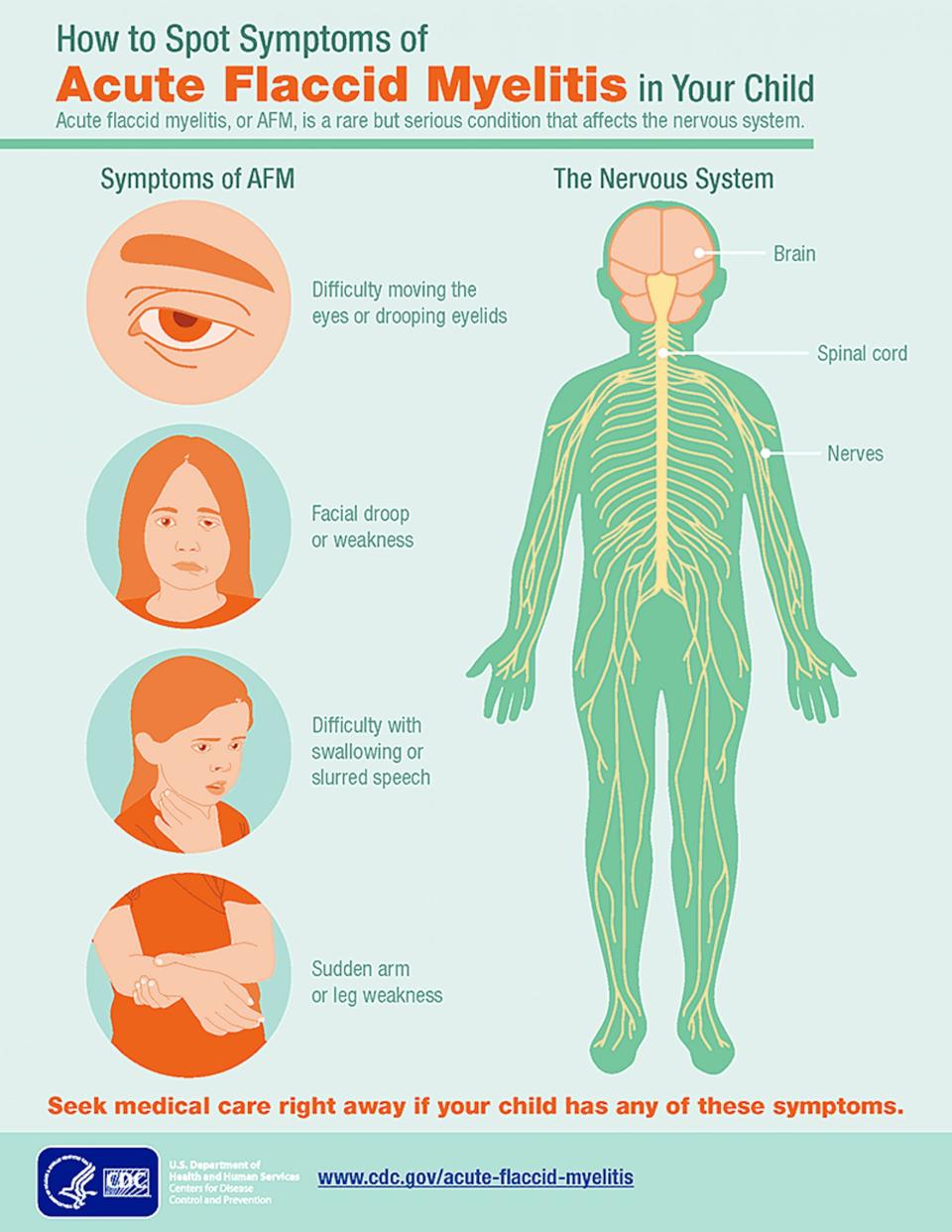 acute flaccid myelitis