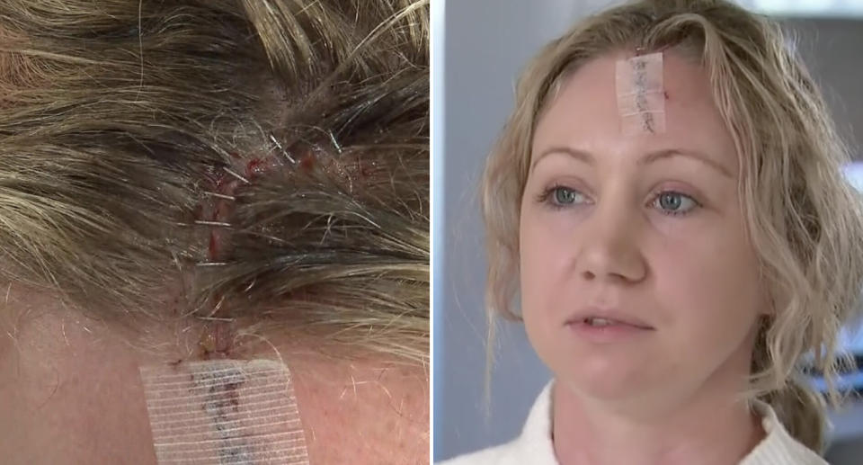 Bec Davies is pictured along with staples in her head after an injury.