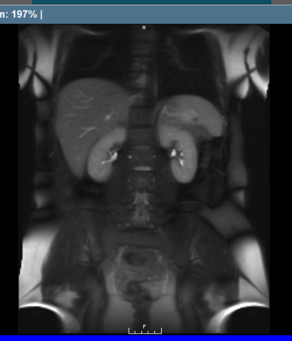 The scan takes an an image of each part of the body, including the abdomen, to look at each of the organs. This is the image of my abdomen from the scan. (Photo via Aleah Balas, Whole Body MRI) 