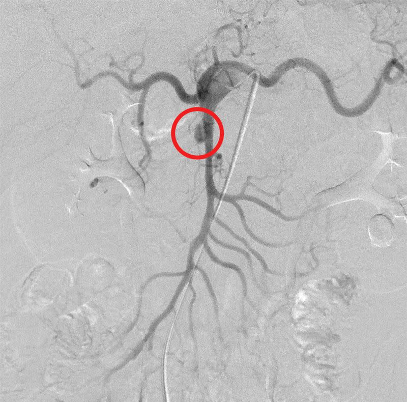 上腸繫膜動脈剝離性動脈瘤(紅圈處)（圖／光田醫院提供）