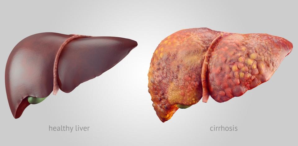 Healthy and diseased liver