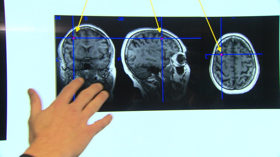 Brain scans illustrate the Stanford Accelerated Intelligent Neuromodulation Therapy (SAINT) procedure being tested on depression patients.  / Credit: CBS News