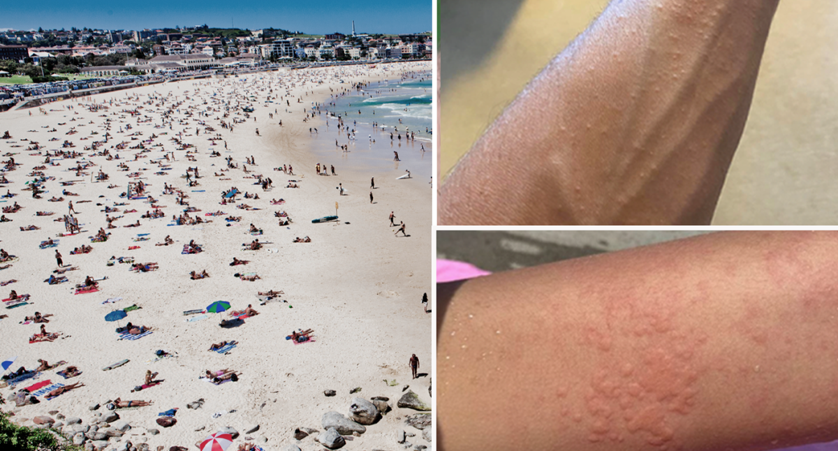 Aussies stumped by mysterious rash after swimming at popular beaches