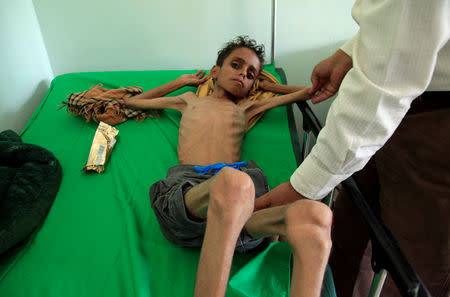 A doctor checks malnourished Ghazi Ahmad, 10, at a hospital in Taiz, Yemen October 30, 2018. Picture taken October 30, 2018. REUTERS/Anees Mahyoub