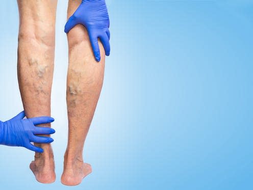 <span class="caption">Varicose veins typically happen in the legs, though any superficial vein may become varicosed.</span> <span class="attribution"><a class="link " href="https://www.shutterstock.com/image-photo/lower-limb-vascular-examination-because-suspect-762632605" rel="nofollow noopener" target="_blank" data-ylk="slk:Solarisys/ Shutterstock;elm:context_link;itc:0;sec:content-canvas">Solarisys/ Shutterstock</a></span>