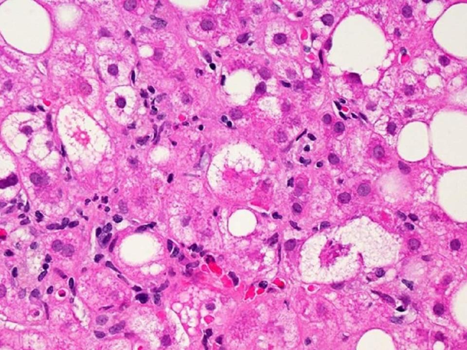 A microscopic image of liver tissue. Cases of unexplained hepatitis, or liver inflammation, are being investigated around the world, with hundreds of children impacted but no known cause.  (National Institutes of Health - image credit)