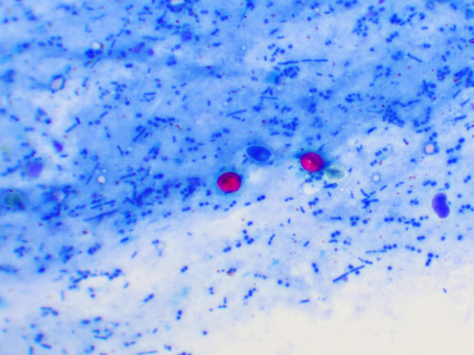 Cryptosporidium parvum protozoa positive (red sphere shape) in human stool smear, oocyst stage, acid-fast stain, analyze by microscope