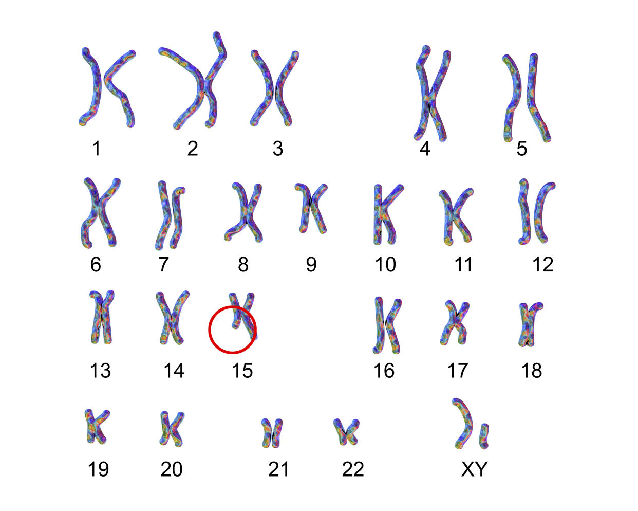 Karyotype of Angelman syndrome (AS), computer illustration. AS is a genetic disorder characterised by arm flapping, excessive laughing (even when hurt), a jerky gait and learning problems. It is caused by genes being deleted or inactivated (switched off) on the copy of chromosome 15 that is inherited from the mother. Roughly one in 15,000 individuals have the condition. Life expectancy is normal, however those with AS are unable to live independently. If the same defect is on the paternal chromosome instead, it causes Prader-Willi syndrome. Labelled version of the illustration.