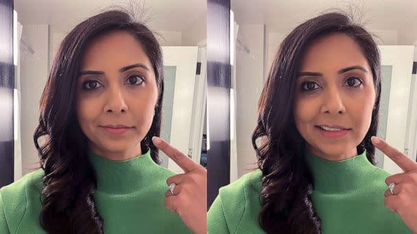 PHOTO: Zohreen Shah was diagnosed with Bell's palsy in January. She's pointing to the side of her face that temporarily could not move (Zohreen Shah/ABC News)