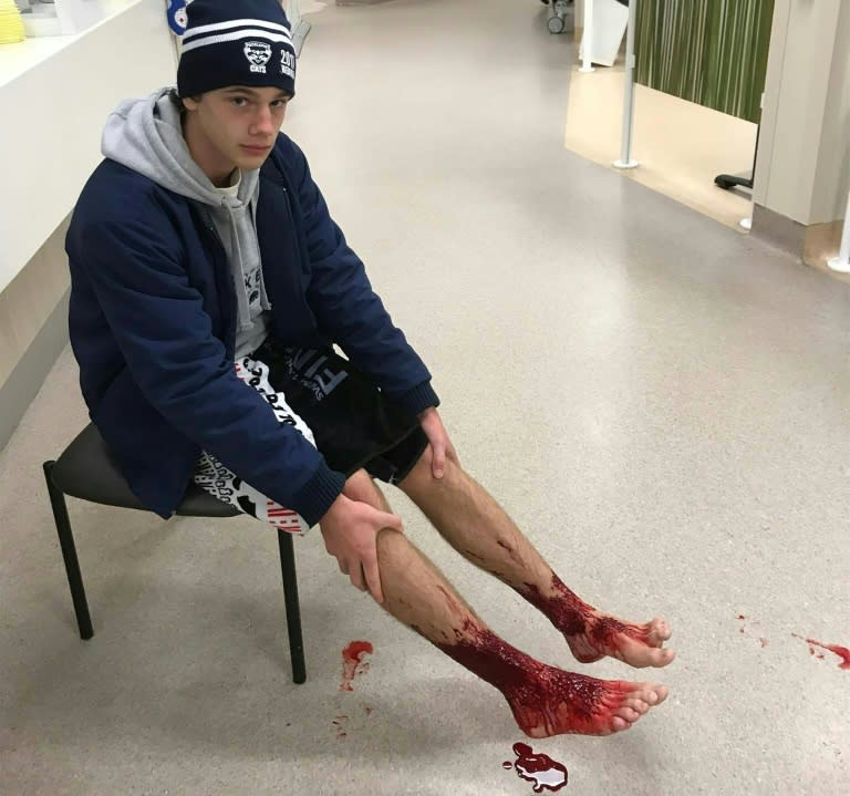 Sam Kanizay with his injured feet waiting for medical aid at a hospital in Melbourne (AFP)