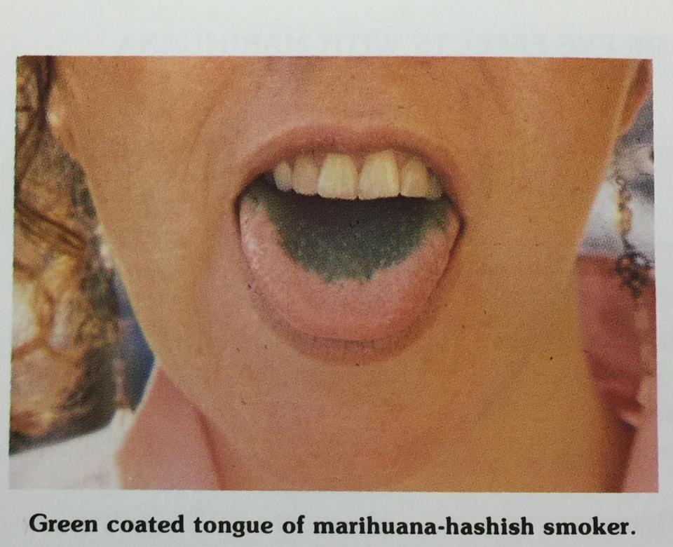 Forest Tennant, a physician in California, wrote a guide called "Identifying the Marihuana User" in 1986, which included this picture.