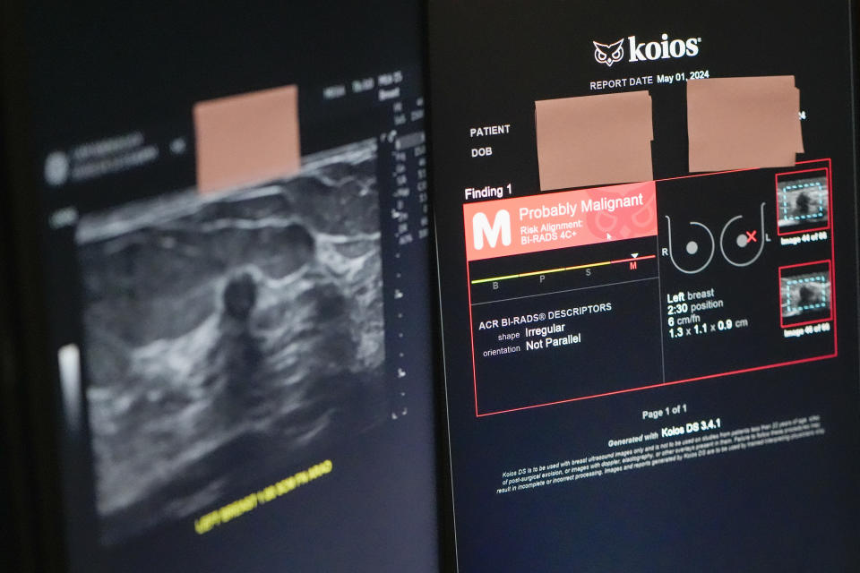 The Koios DS Smart Ultrasound software, used to get a second opinion on mammography images, is seen on a computer screen, Wednesday, May 8, 2024, at Mount Sinai hospital in New York. In the near term, experts say AI will work like autopilot systems on planes — performing important navigation functions, but always under the supervision of a human pilot. (AP Photo/Mary Altaffer)