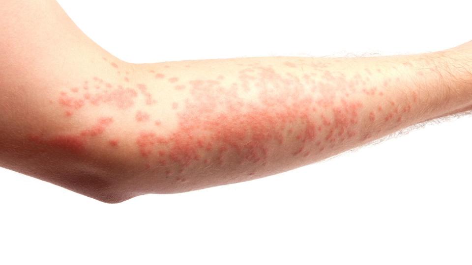 skin allergy