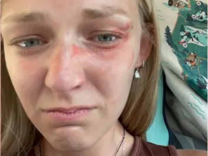 A photo of Gabby Petito showing blood and bruises on her face just before her and her ex-fiance Brian Laundrie were stopped by Moab police officers investigating a domestic abuse call (Parker and McConkie lawfirm)