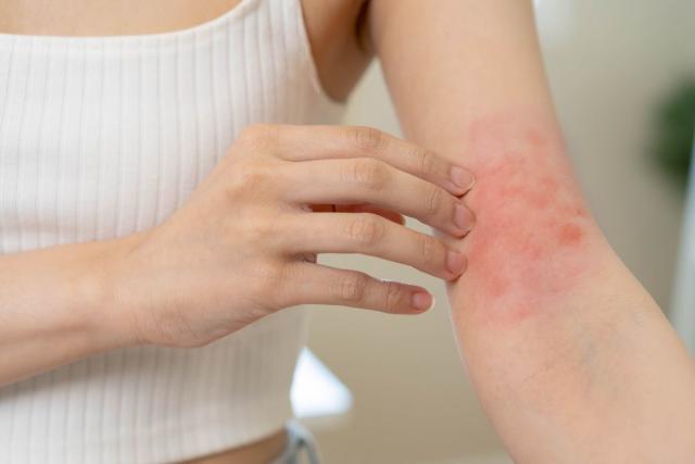 Bouton d'allergie : causes, symptômes et traitements