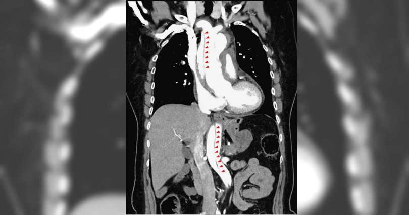 狀如拐杖的主動脈，上行部分稱為升主動脈，轉彎部分是主動脈弓，下行部分則為降主動脈。（圖／臺北市立聯合醫院提供）