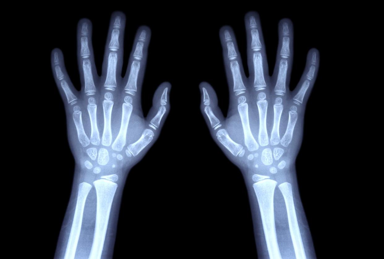 Huesos de la mano de un niño <a href="https://www.shutterstock.com/es/image-photo/film-xray-normal-both-hands-child-324011912" rel="nofollow noopener" target="_blank" data-ylk="slk:Puwadol Jaturawutthichai/Shutterstock;elm:context_link;itc:0;sec:content-canvas" class="link ">Puwadol Jaturawutthichai/Shutterstock</a>