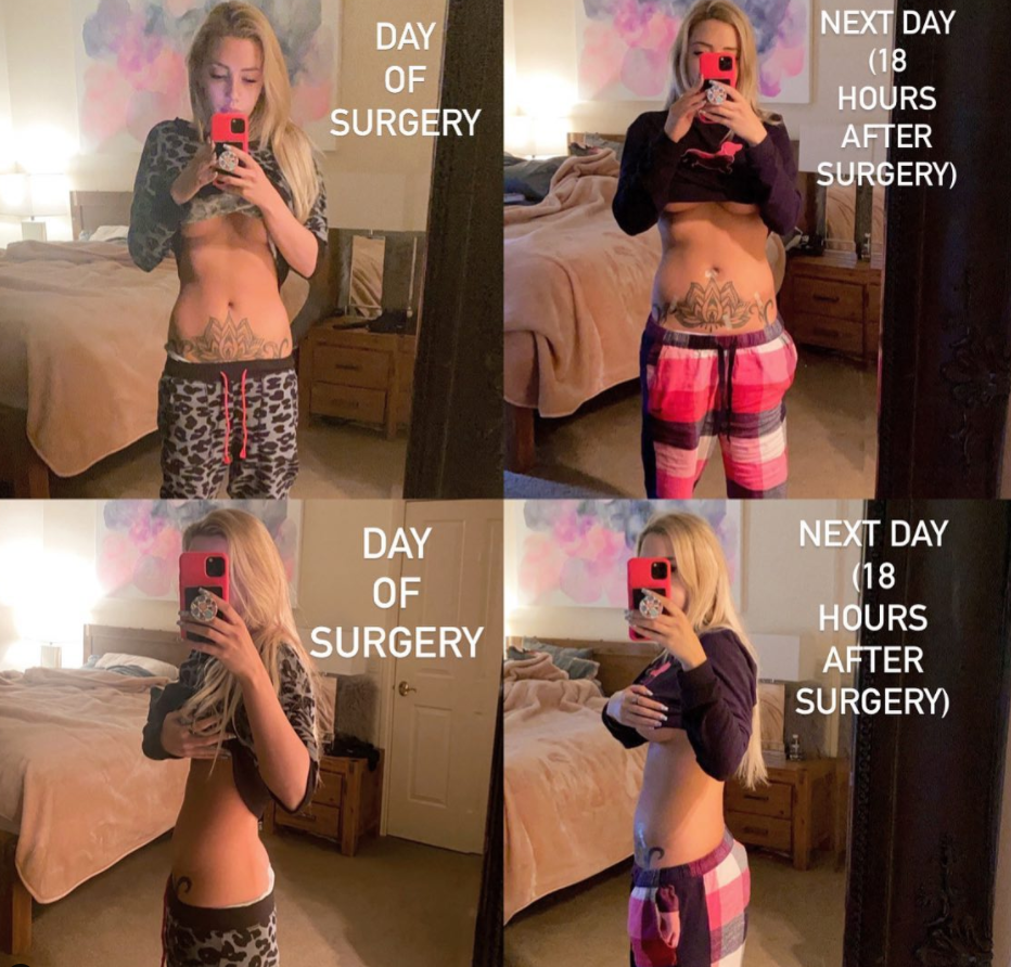 Erin Barnett's endo surgery update on Instagram