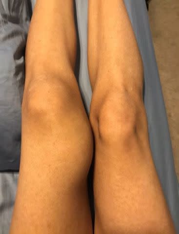 <p>Dori Maddry</p> MacKenzie Maddry shows the swelling on her leg.